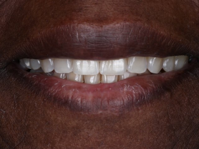 Porcelain veneers, actual patient of Dr. Silvestrini