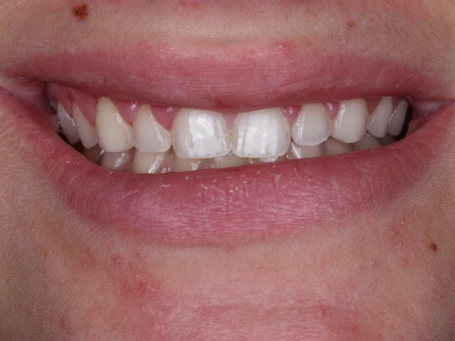 Gingival recontouring, actual patient of Dr. Silvestrini