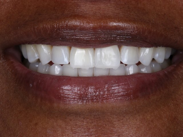 Composite veneers, Bioclear matrix, actual patient of Dr. Silvestrini