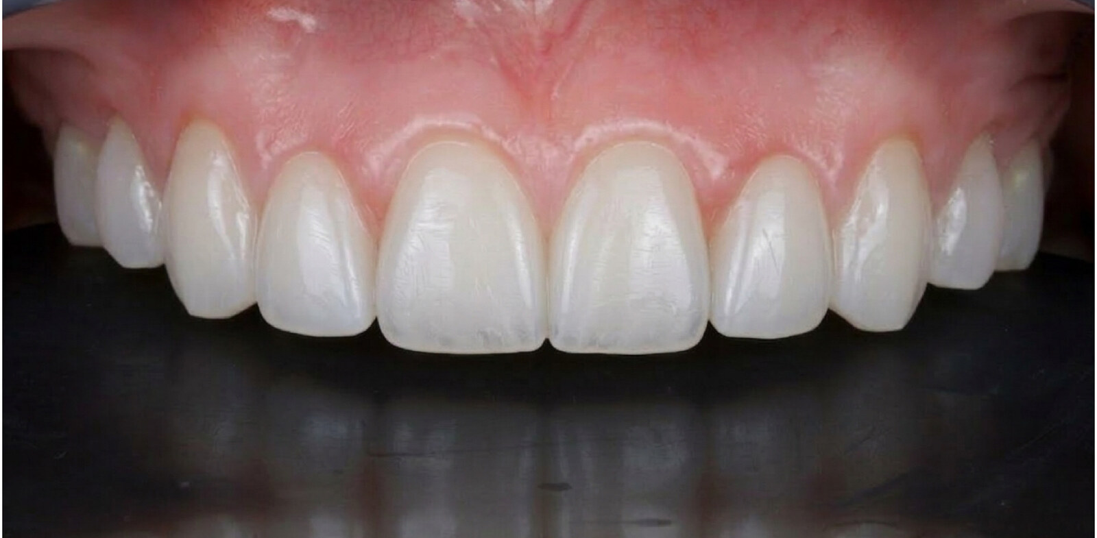 After: Orthodontic finishing to final porcelain veneers
