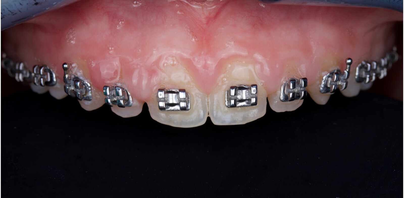 Before: Orthodontic finishing to final porcelain veneers
