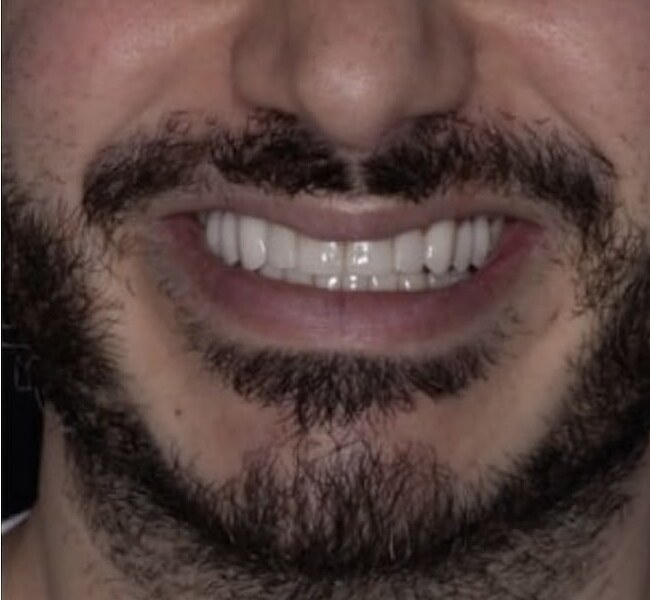 After: Full smile transformation, porcelain veneers