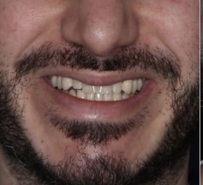 Before: Full smile transformation, porcelain veneers