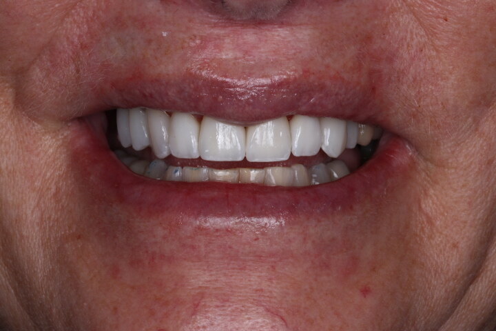 After: Worn, discolored teeth to porcelain veneers