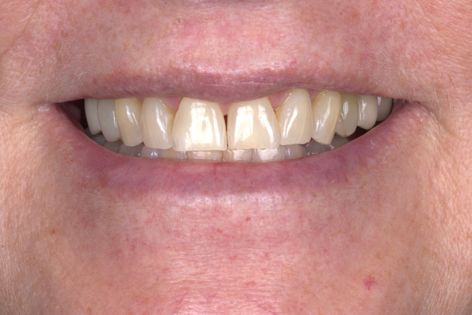 Before: Worn, discolored teeth to porcelain veneers