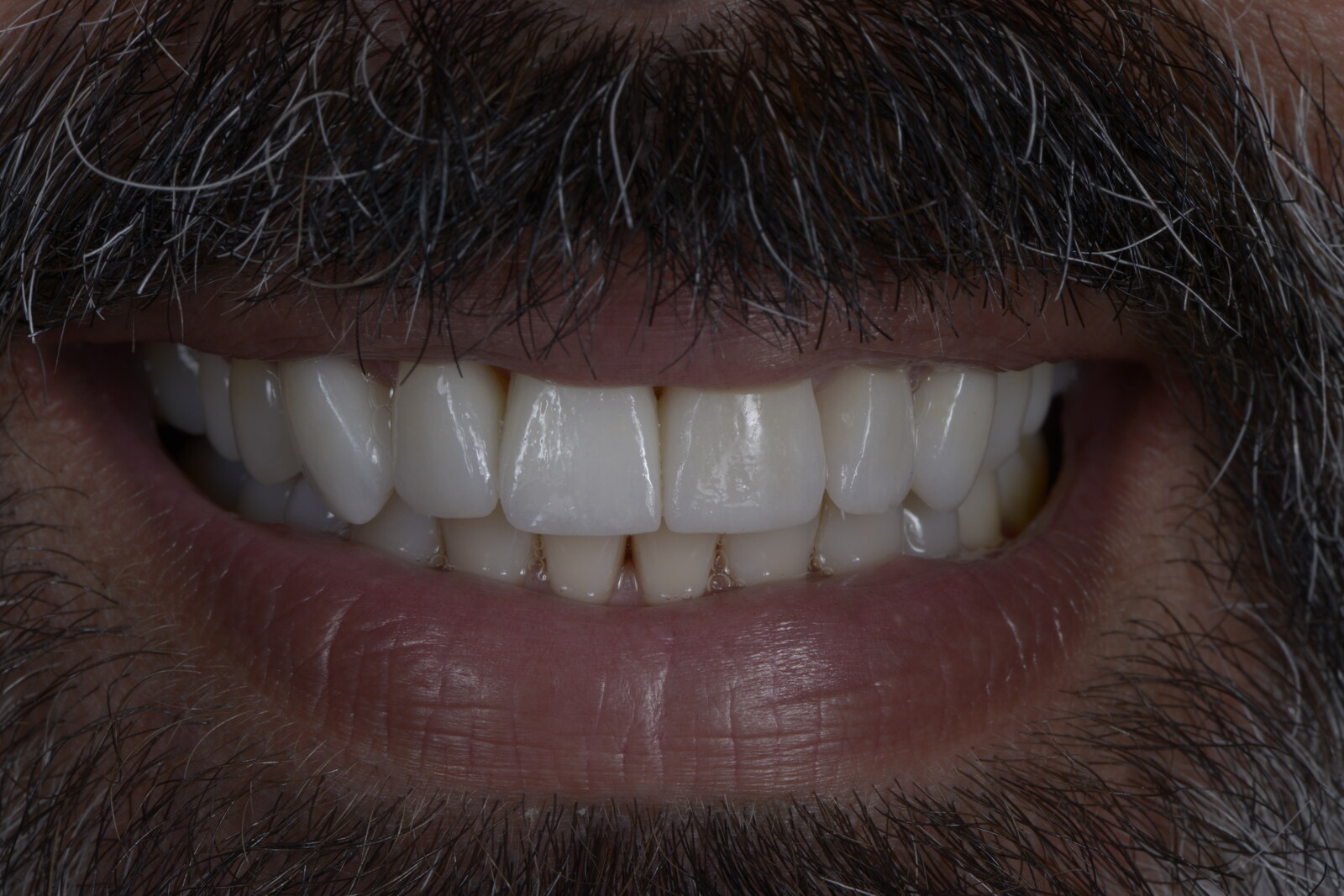 Porcelain veneers, actual patient of Dr. Silvestrini