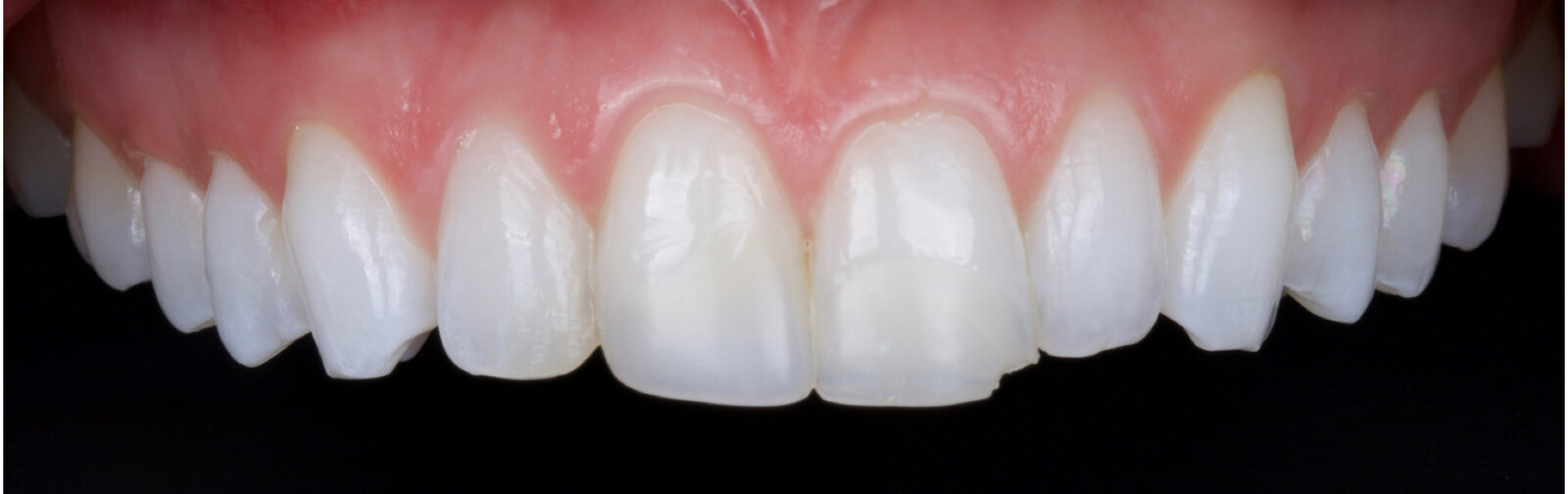 Digital smile design, final result, actual patient of Dr. Silvestrini