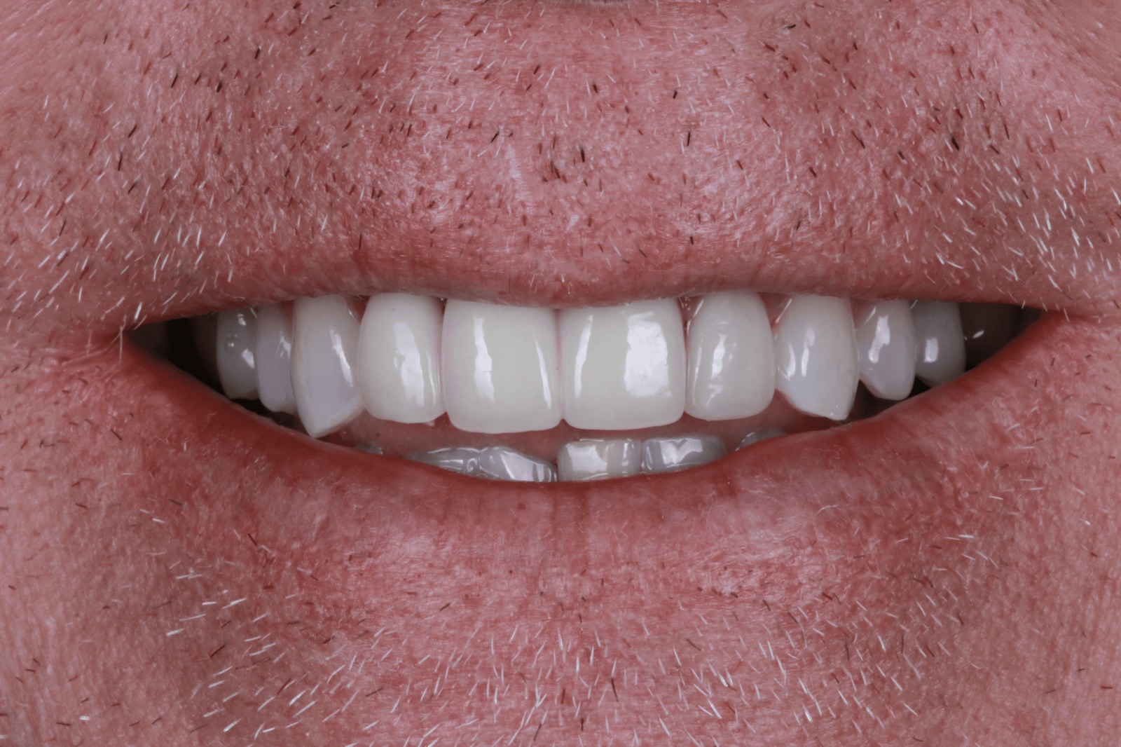 Final composite, actual patient of Dr. Silvestrini