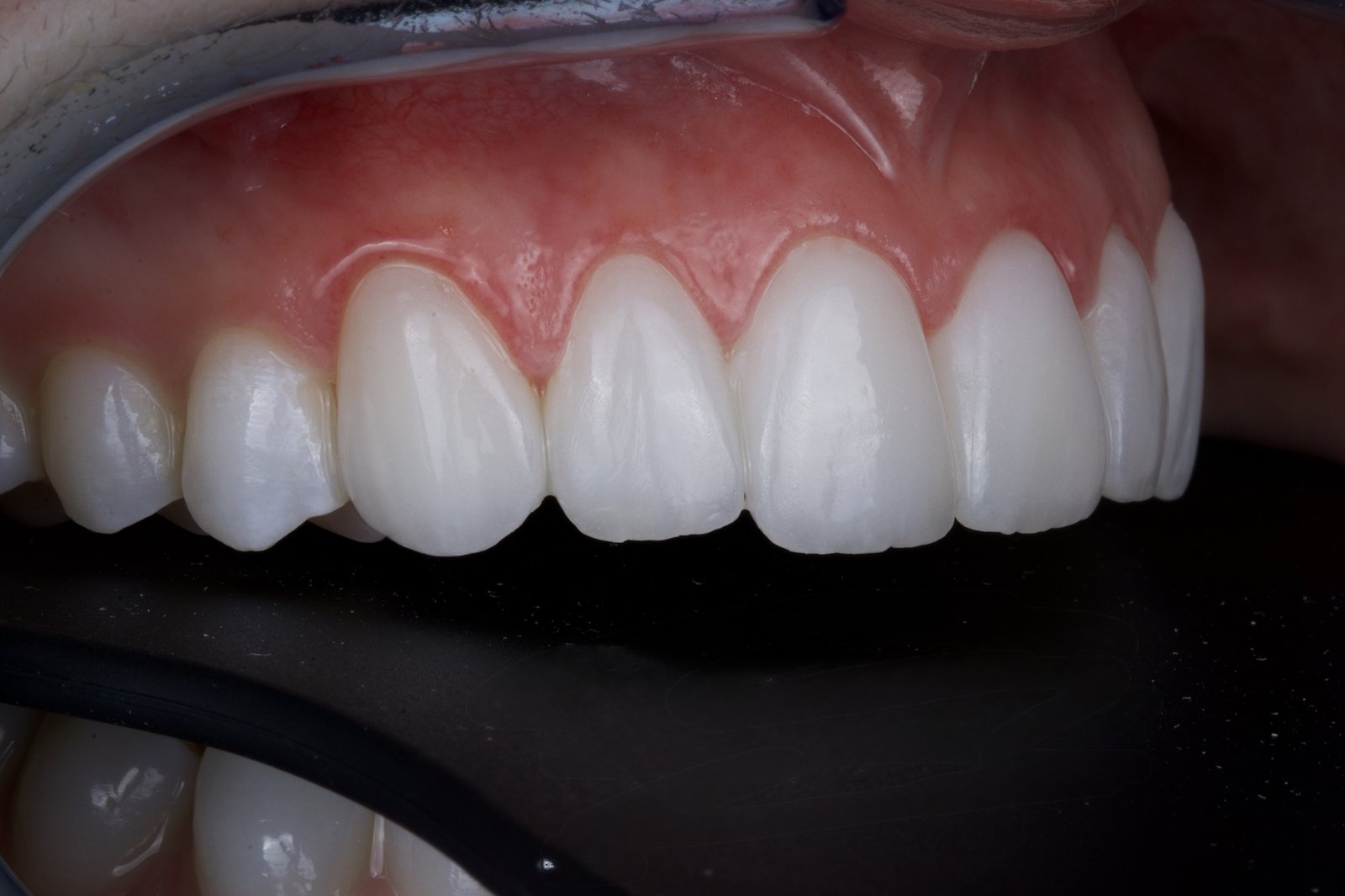 Actual patient of Dr. Silvestrini: finished ceramic restorations, close up